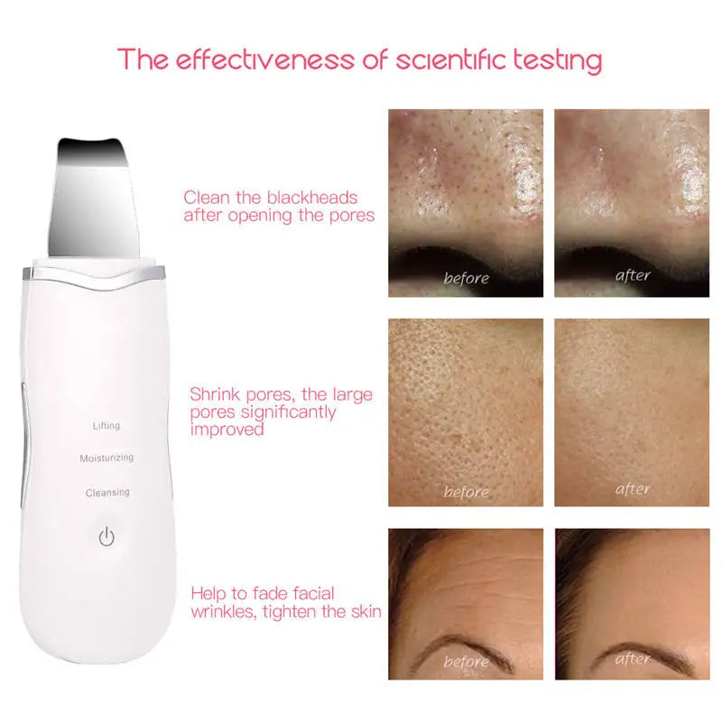 3-in-1 Ultrasonic Facial Skin Scrubber and Pore Cleaner - 5