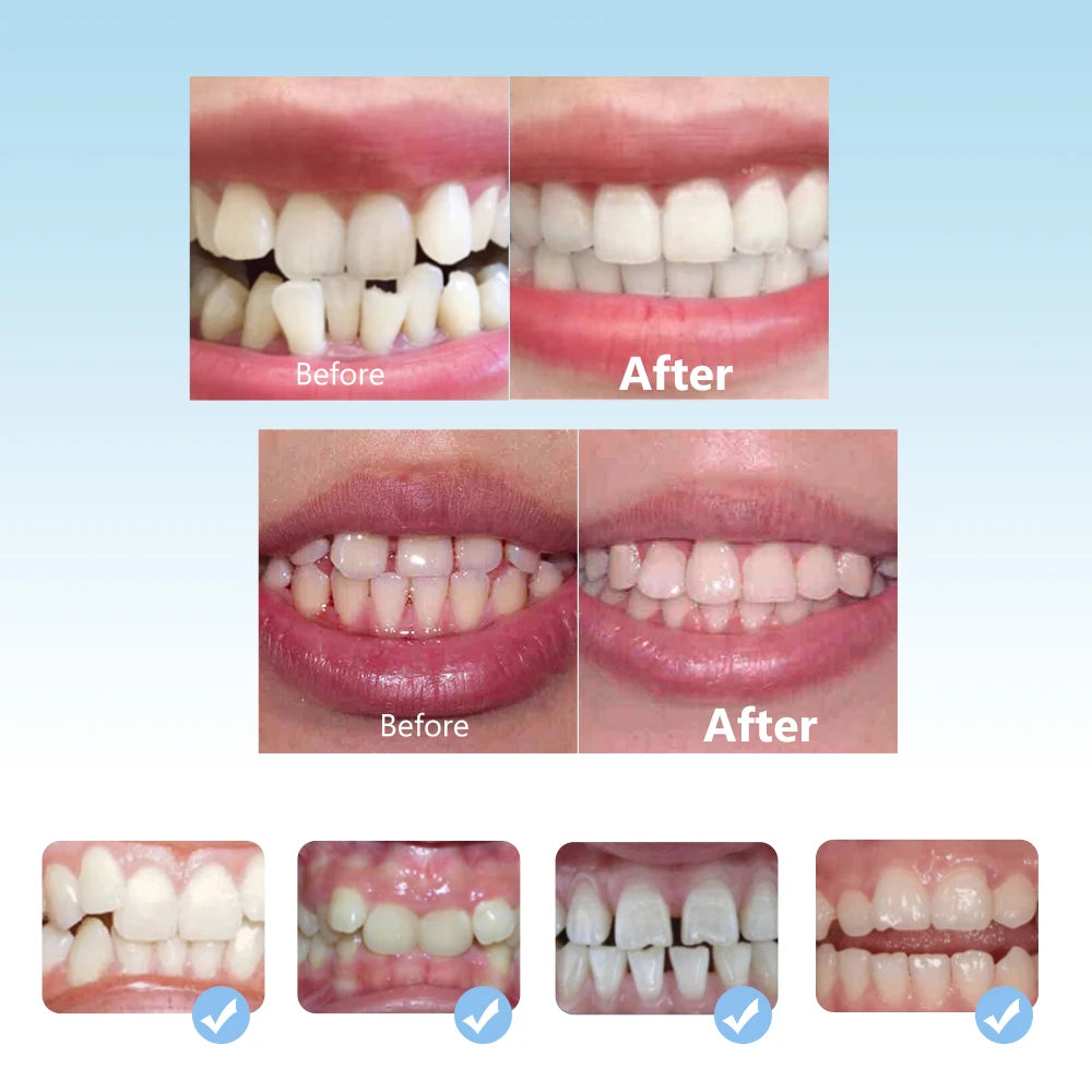 3-Stage Kids Orthodontic Teeth Alignment Trainer Set - 7