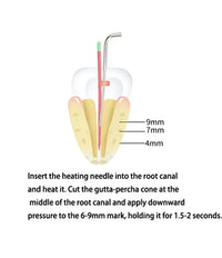 Wireless Dental Gutta-Percha Obturation System