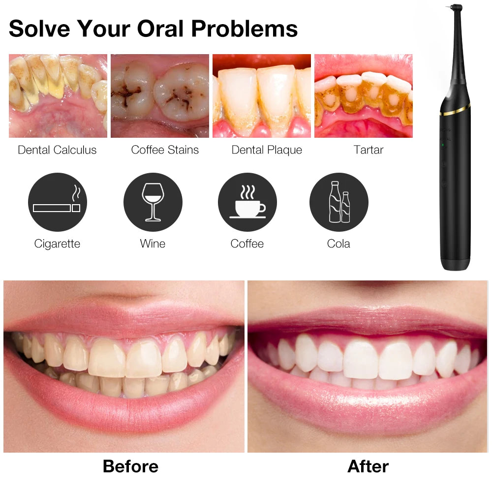 Electric Ultrasonic Tooth Tartar Remover and Teeth Whitening Tool - 5