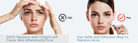 5-Piece Stainless Steel Blackhead and Acne Removal Kit