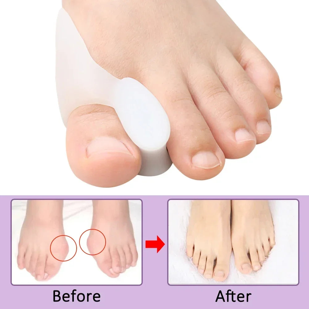 Gel Bunion Corrector and Toe Spacer for Pain Relief - 8