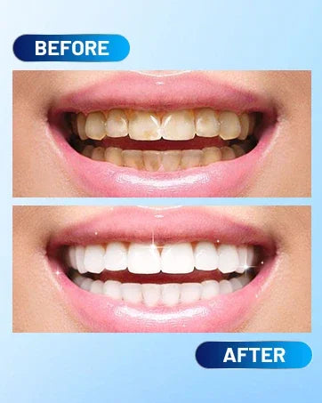LED Teeth Whitening Kit for Sensitive Teeth - 19