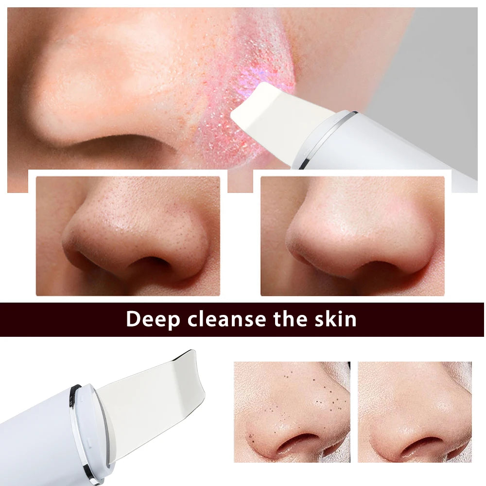 Ultrasonic Facial Skin Scrubber for Deep Pore Cleansing - 9