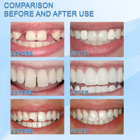Moldable Temporary Tooth Repair Kit for Gaps and Broken Teeth