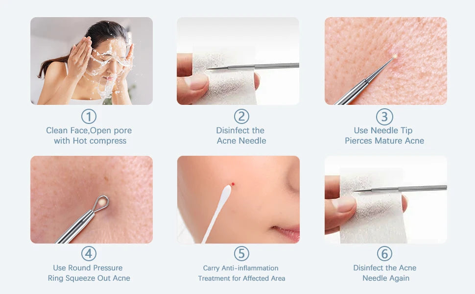 5-Piece Stainless Steel Blackhead and Acne Removal Kit - 19