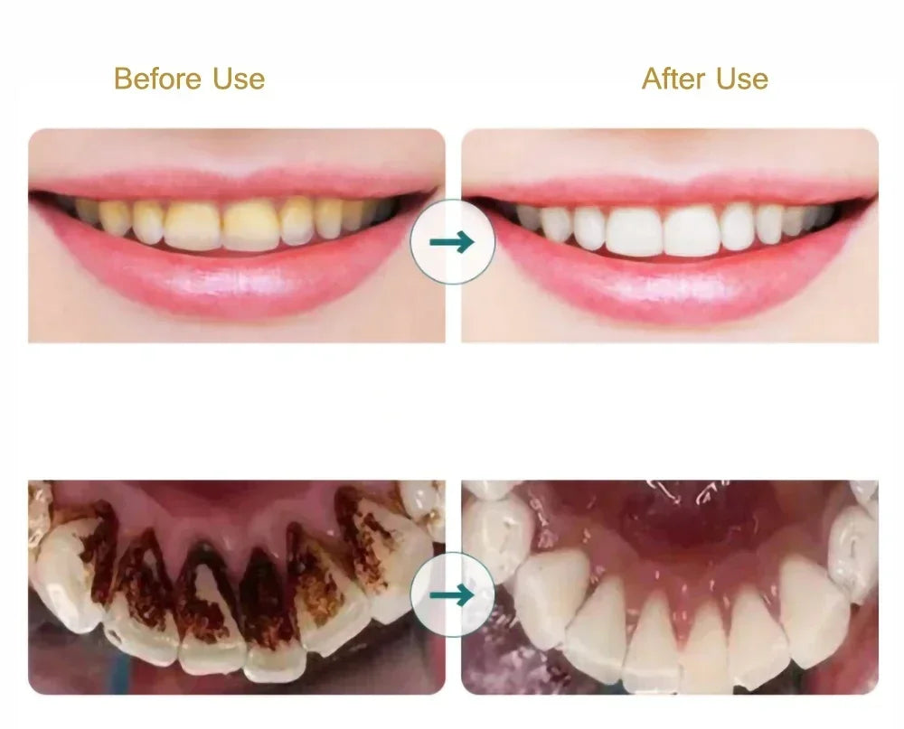 Electric Sonic Teeth Tartar Remover and Plaque Cleaner - 13
