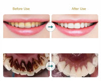 Electric Sonic Teeth Tartar Remover and Plaque Cleaner