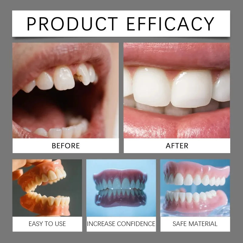 Custom-Fit Temporary Cosmetic Veneers - 4
