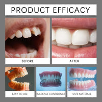 Custom-Fit Temporary Cosmetic Veneers