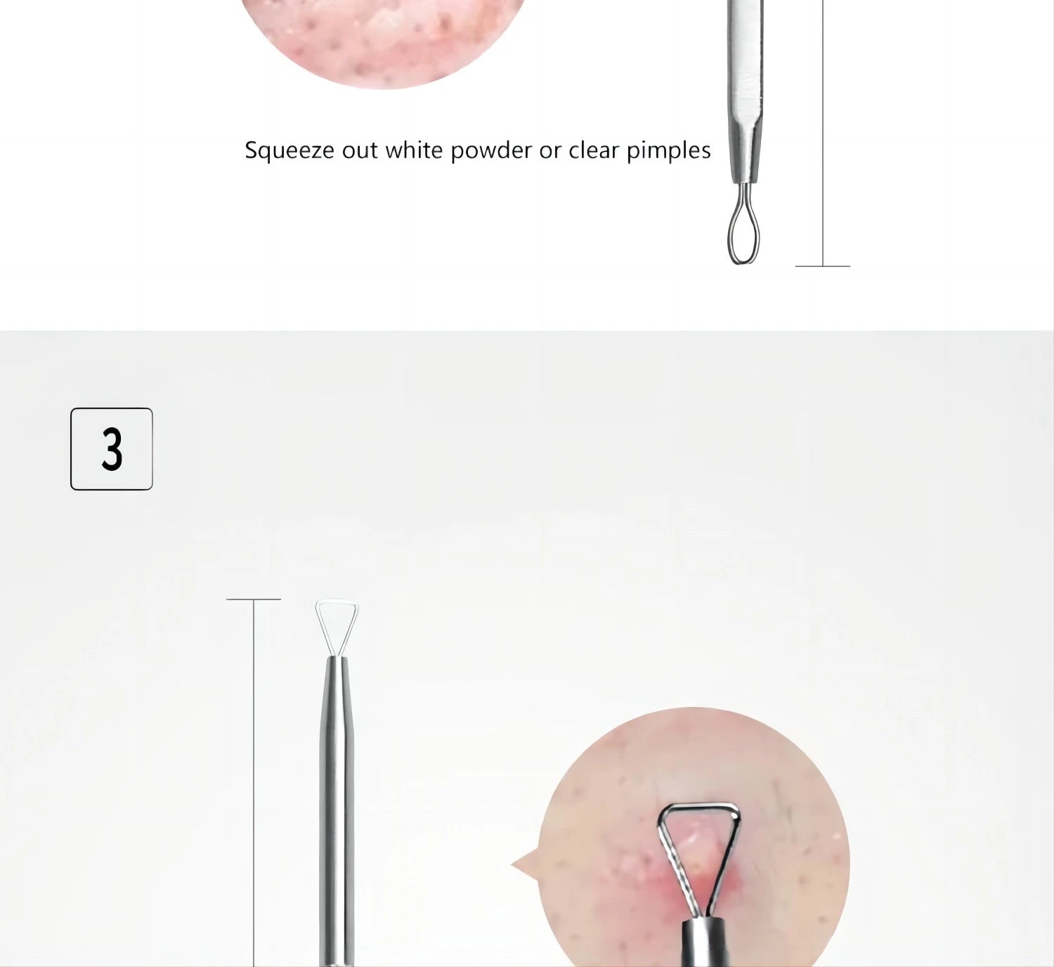 5-Piece Stainless Steel Blackhead and Acne Removal Kit - 14