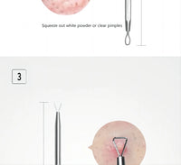5-Piece Stainless Steel Blackhead and Acne Removal Kit
