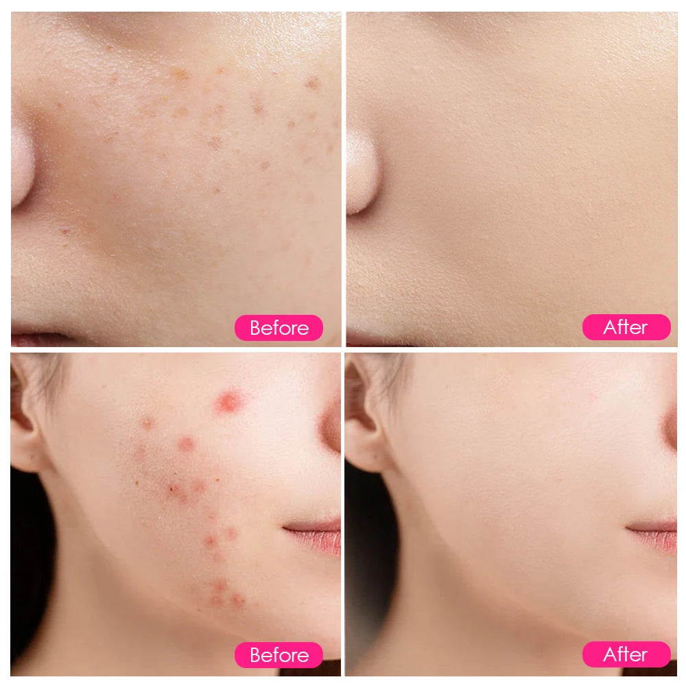 LED Photon Therapy Lamp for Acne and Skin Rejuvenation - 8