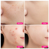 LED Photon Therapy Lamp for Acne and Skin Rejuvenation