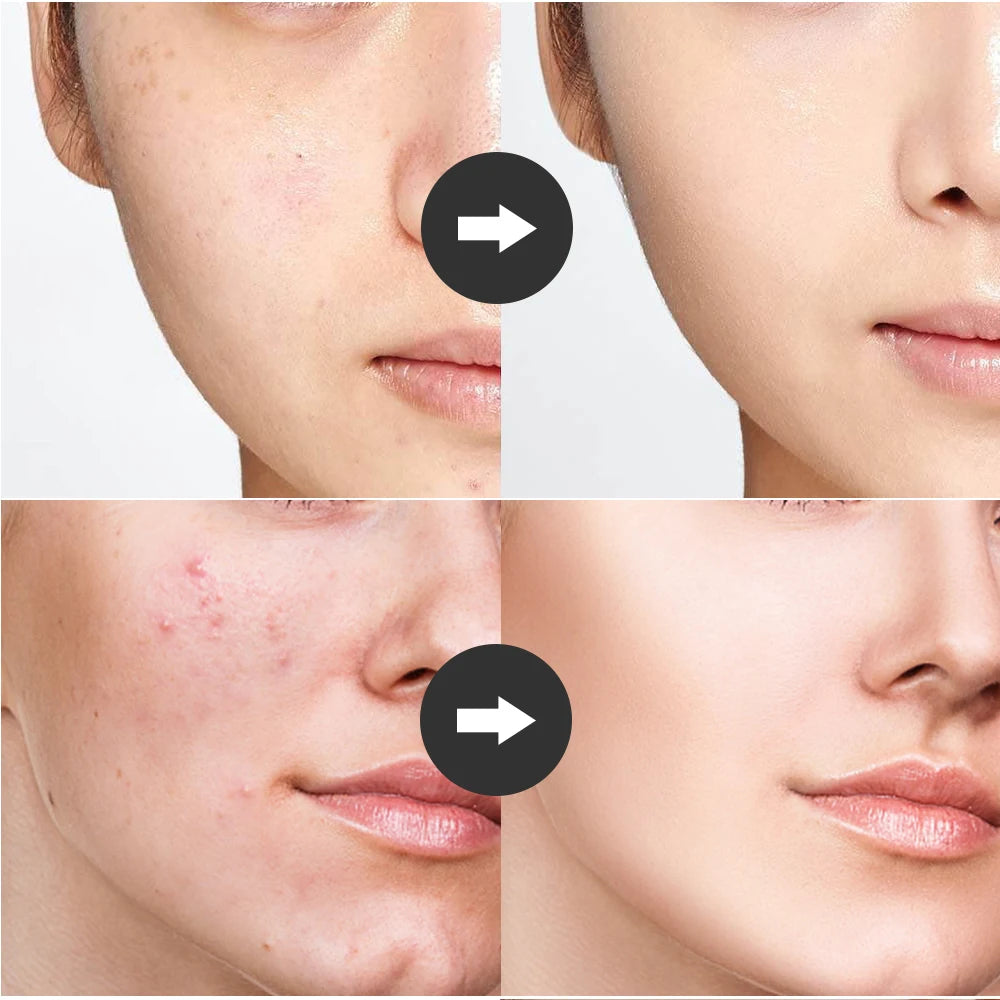 4-in-1 High-Frequency Facial Wand for Acne and Anti-Aging - 11