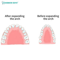 Orthodontic Rapid Palatal Expansion Screw for Dental Arch Correction