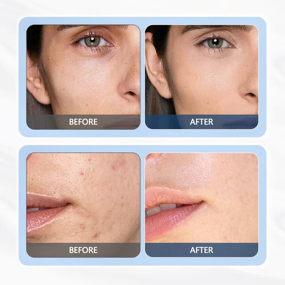 3-in-1 Ultrasonic Facial Lifting and Skin Rejuvenation System - 14