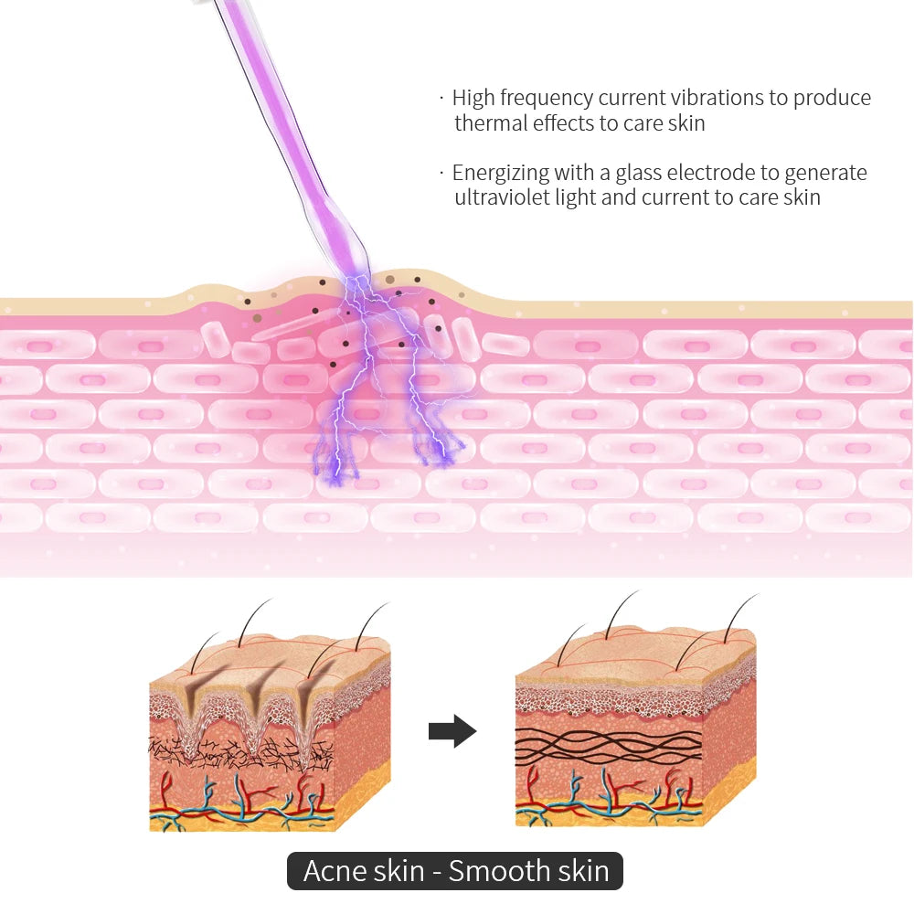 4-in-1 High-Frequency Facial Wand for Acne and Anti-Aging - 3
