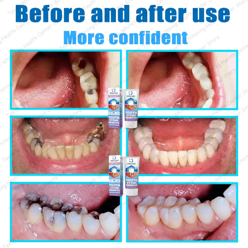 Advanced Dental Repair and Cavity Removal Treatment - 5