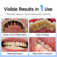 Electric Ultrasonic Teeth Whitening and Tartar Remover Kit