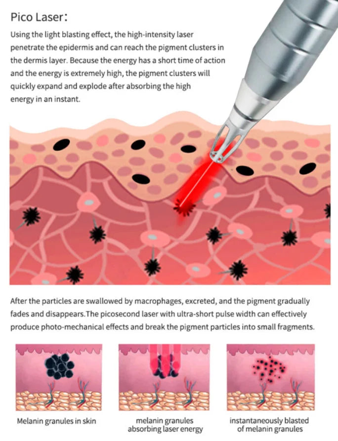 Professional Picosecond Laser Tattoo and Skin Rejuvenation Machine - 21