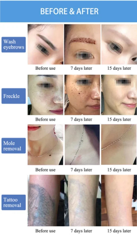Professional Picosecond Laser Tattoo and Skin Rejuvenation Machine - 24