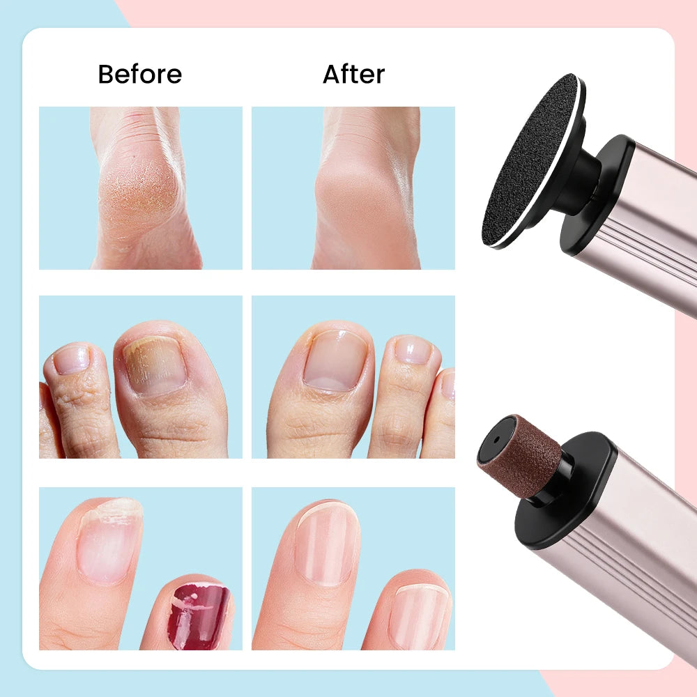 Electric Foot Callus Remover for Smooth & Soft Heels - 34
