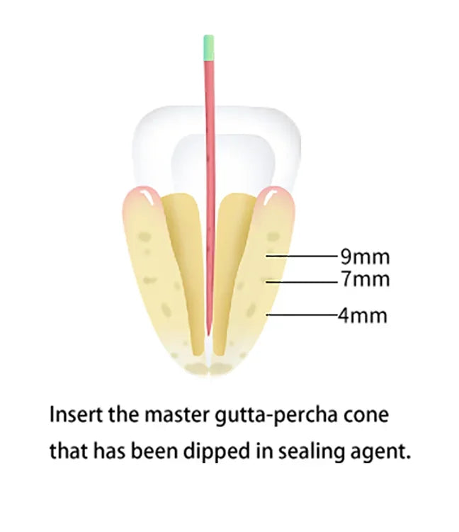 Wireless Dental Gutta-Percha Obturation System - 12