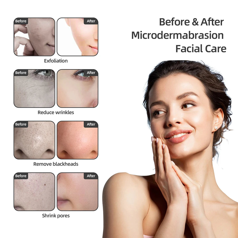 3-in-1 Professional Diamond Microdermabrasion Facial Machine - 3