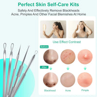 5-Piece Stainless Steel Blackhead and Acne Removal Kit