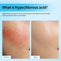 Hypochlorous Acid Soothing Facial Rescue Spray