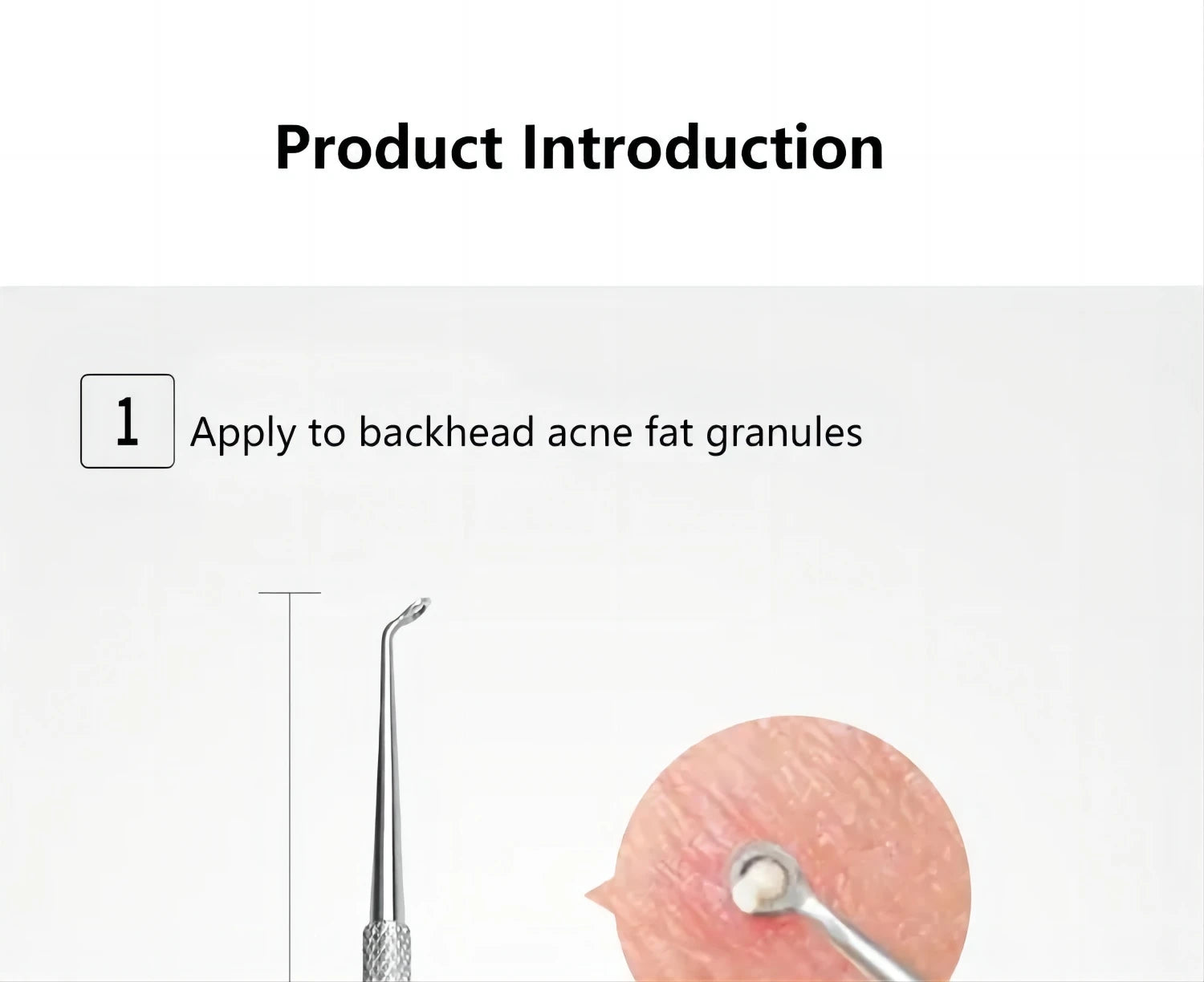 5-Piece Stainless Steel Blackhead and Acne Removal Kit - 11