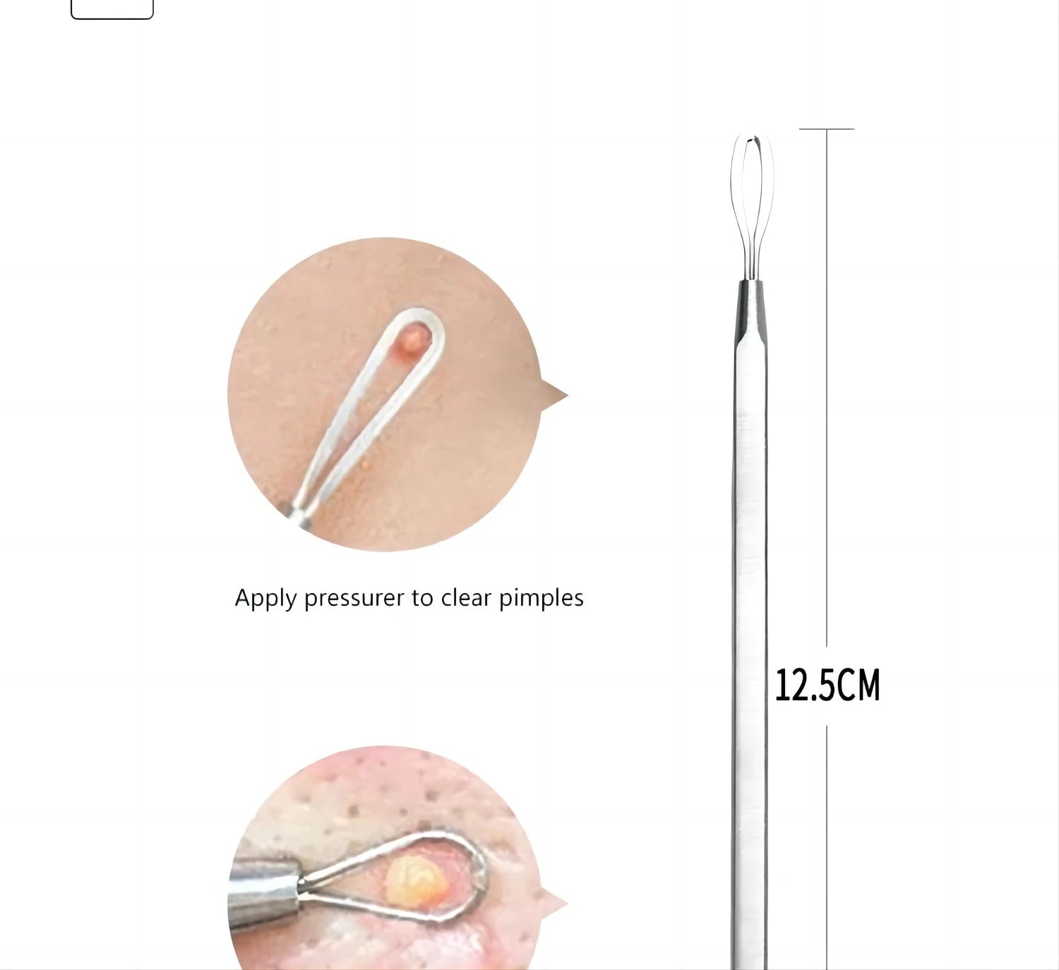 5-Piece Stainless Steel Blackhead and Acne Removal Kit - 13