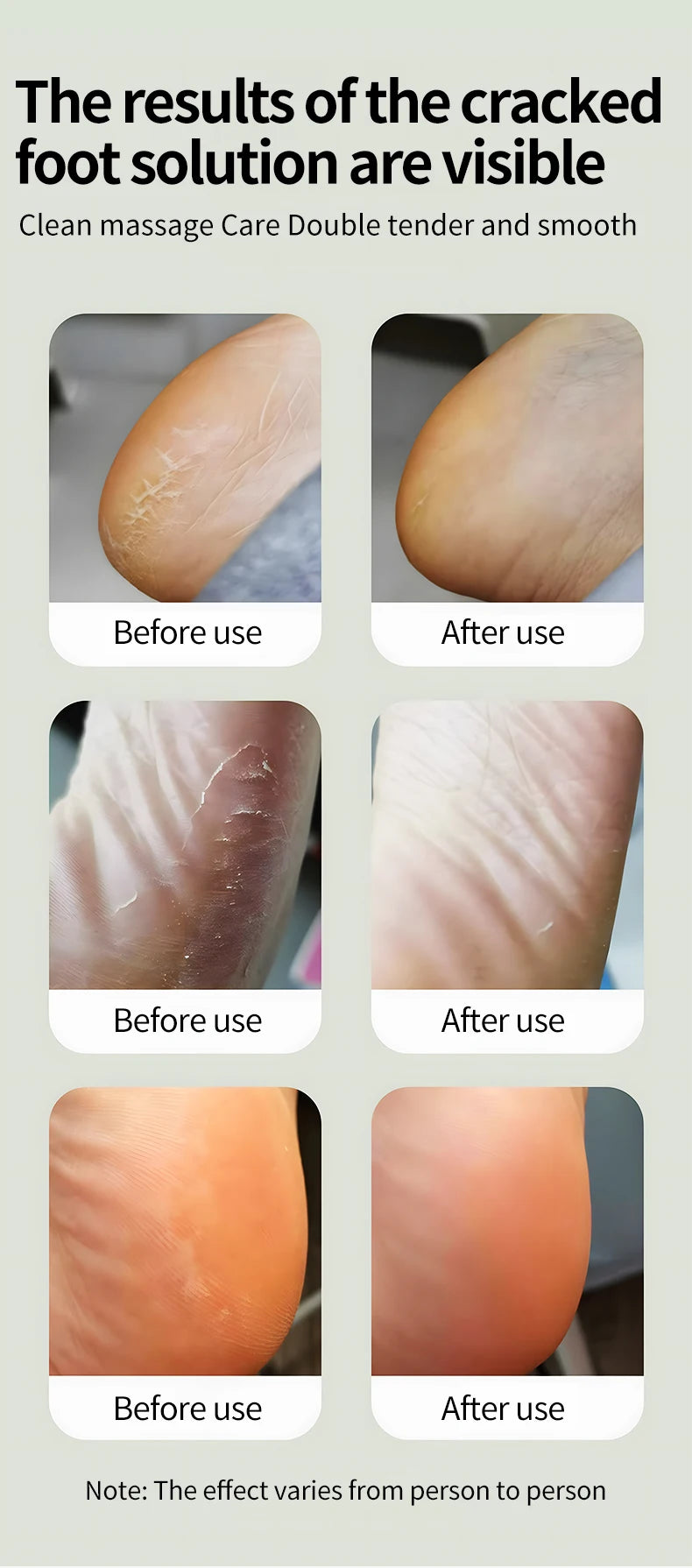 Electric Foot Callus Remover for Smooth Pedicure Results - 10