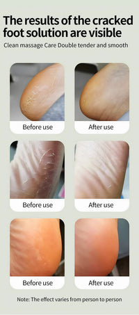 Electric Foot Callus Remover for Smooth Pedicure Results