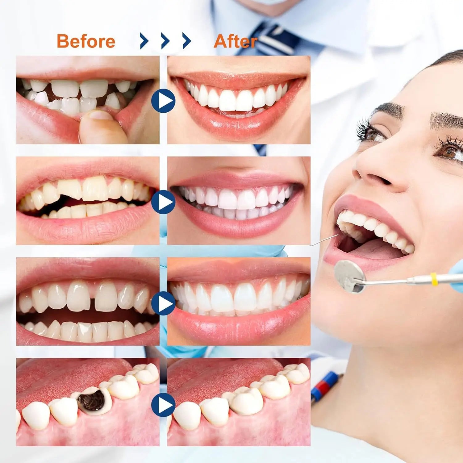 Temporary Tooth Repair Kit for Missing Teeth - 3