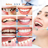 Temporary Tooth Repair Kit for Missing Teeth